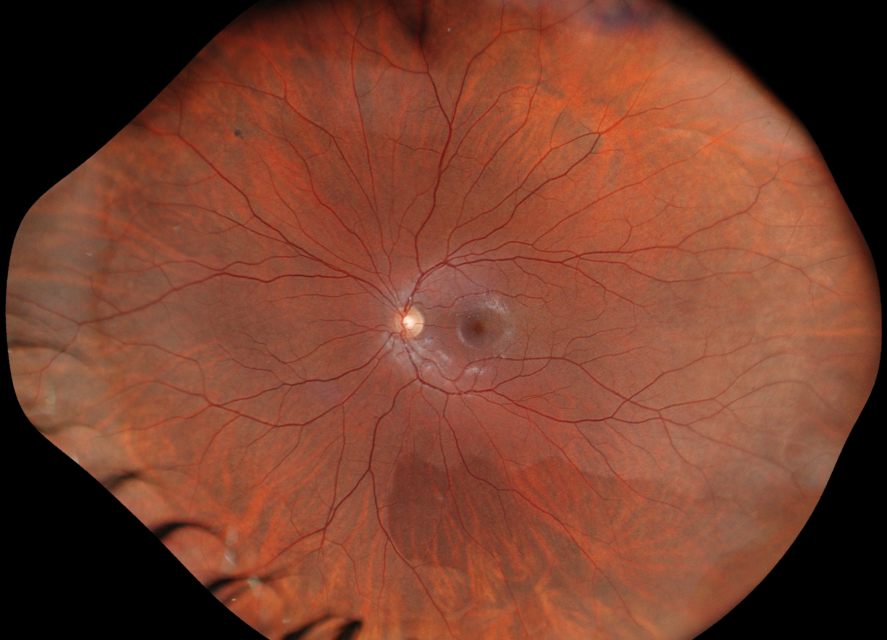 209° ultra-widefield fundus image