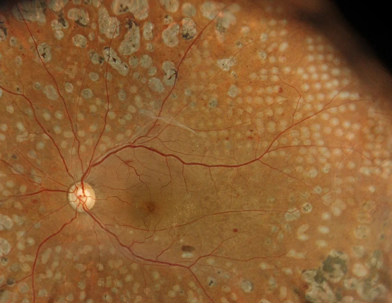 Diabetic retinopathy, true colour fundus image after additional laser