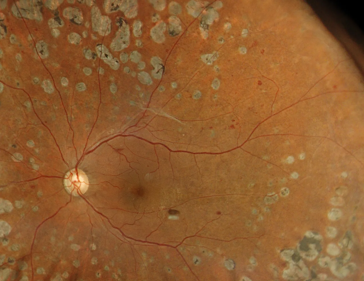 Diabetic retinopathy, true colour fundus image before additional laser